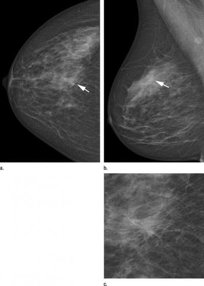 Two-view screening mammograms obtained with the DR photon-counting system