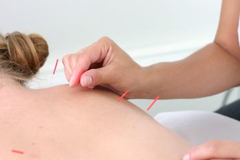 Acupuncture session