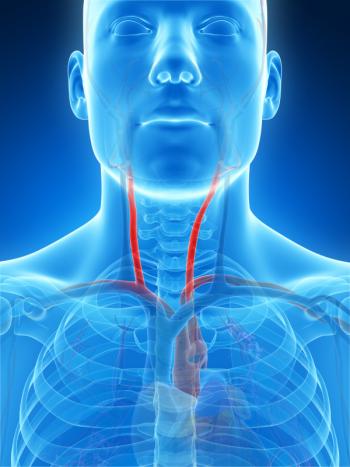 Narrowing of the carotid arteries may lead to memory and thinking problems