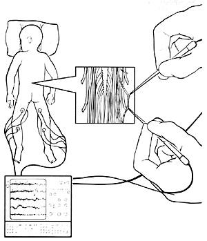 SDR procedure