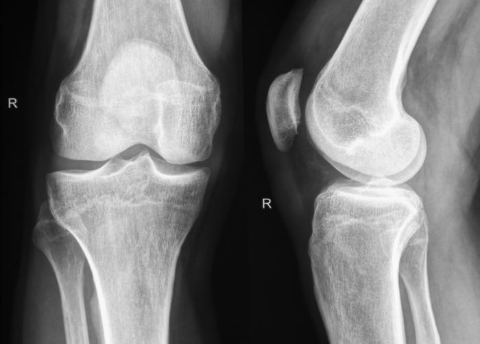 x-ray of knees