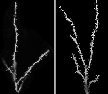 autism synapses