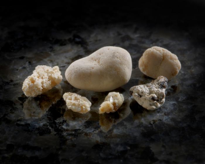 kidney stones