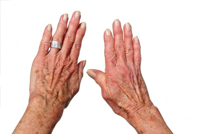 arthritic hands