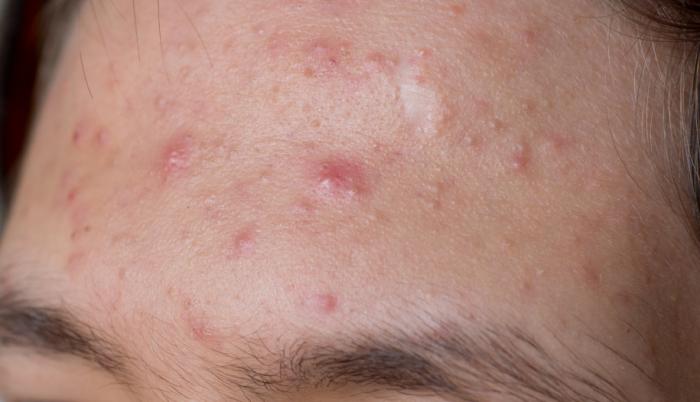 close up of acne on forehead
