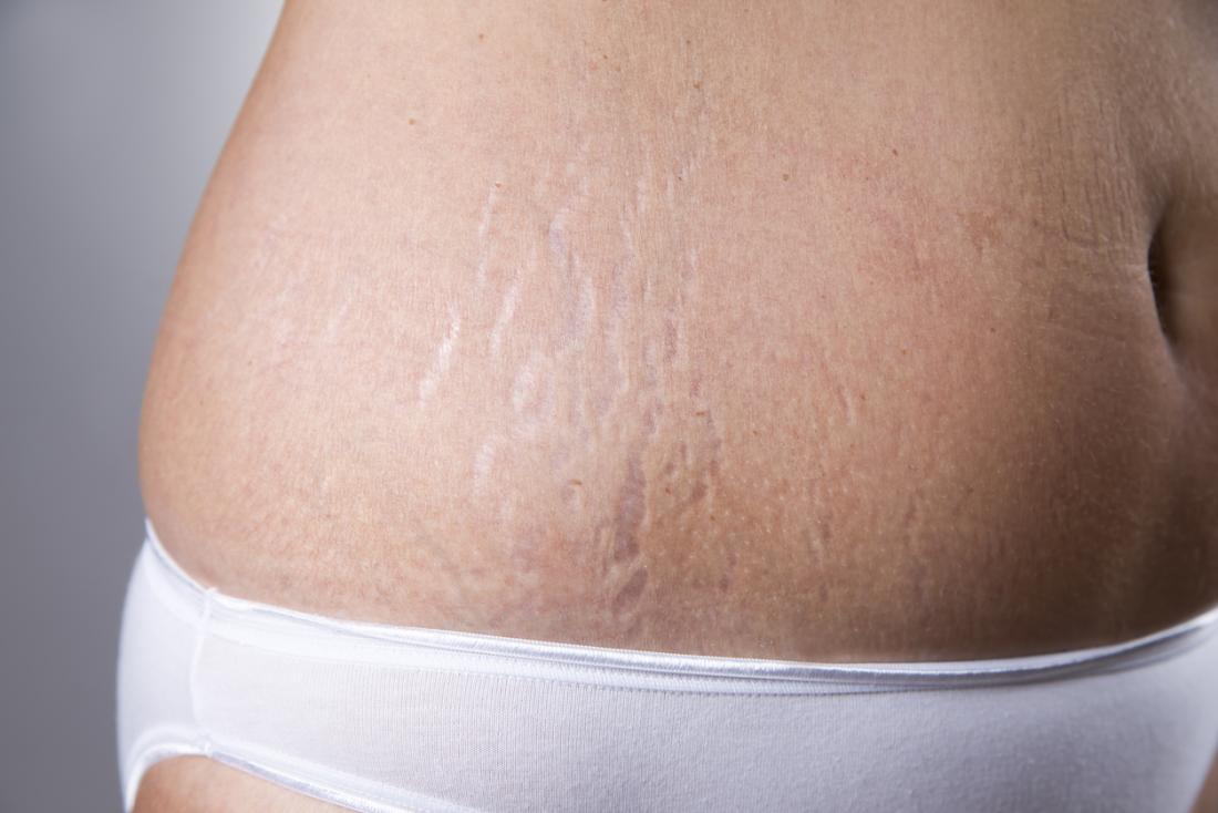All About Stretch Marks and Your Body