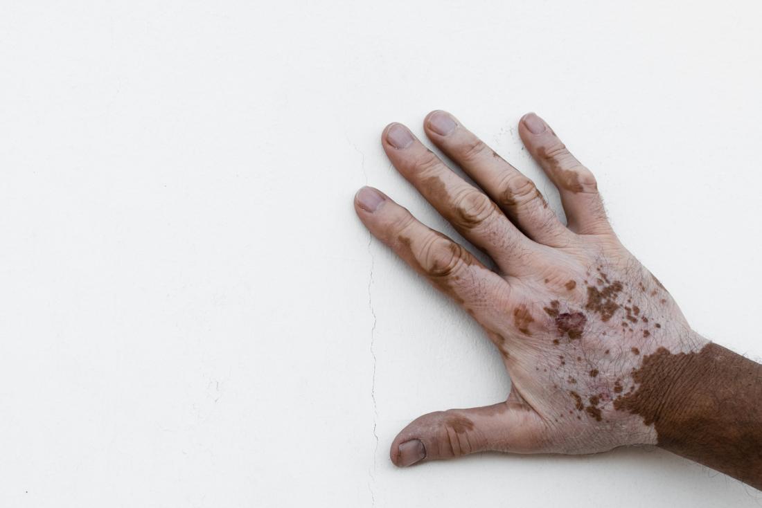 Vitiligo hand
