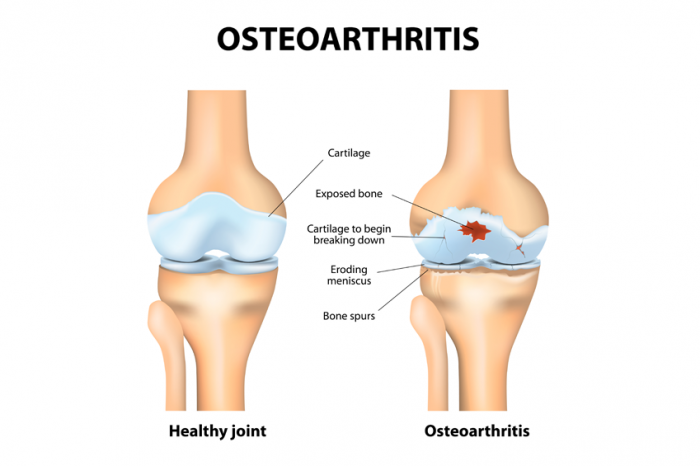 comparison of healthy joint and joint with osteoarthritis