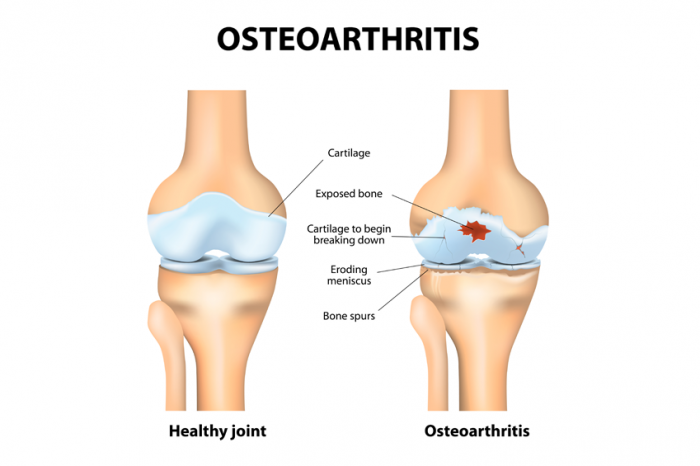 arthritis definition tratamentul artrozei cu un măr adam