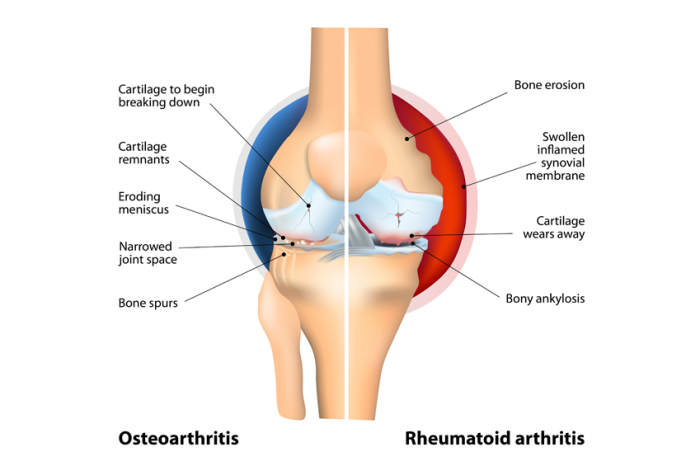 arthritis symptoms and treatments)
