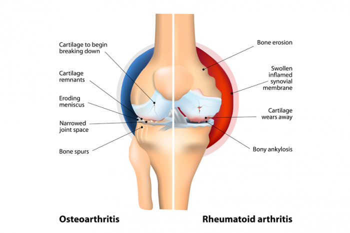 IMPLICATIONS OF VITAMIN D DEFICIENCY IN INFLAMMATION DUE TO RHEUMATOID ARTHRITIS