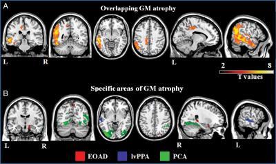 patterns of cortical atrophy