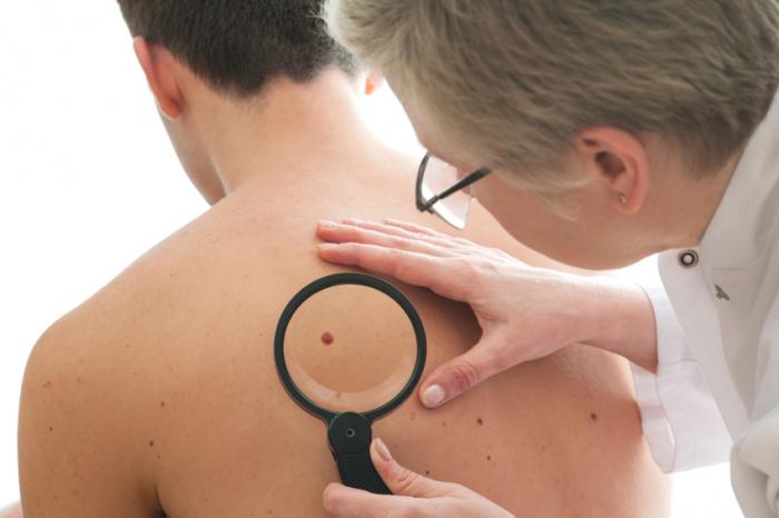 A doctor investigates a mole on a man's back.