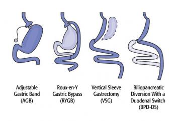 diagram of surgical stomach options