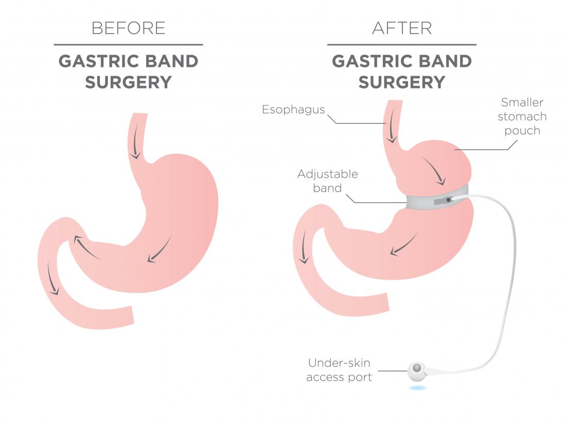 Gastric bands: How it works, surgery, who should have it