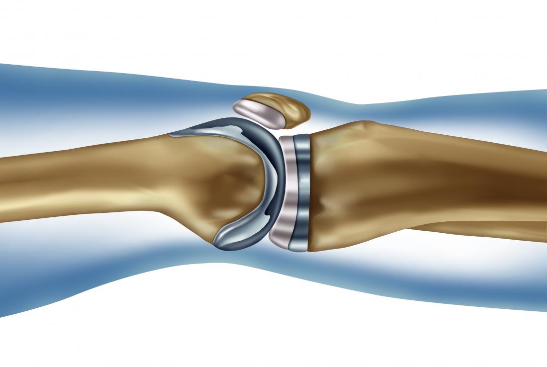 Patients with knee osteoarthritis who had a total knee replacement were found to be at greater risk of heart attack, particularly in the first month after surgery