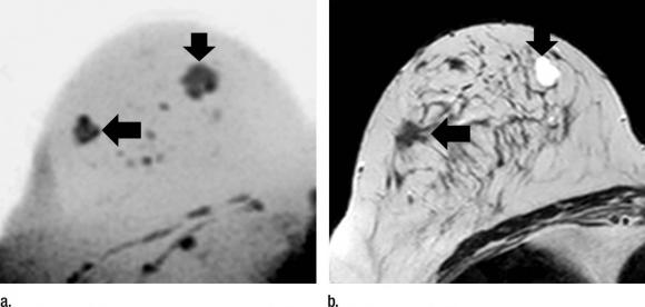 Mammogram