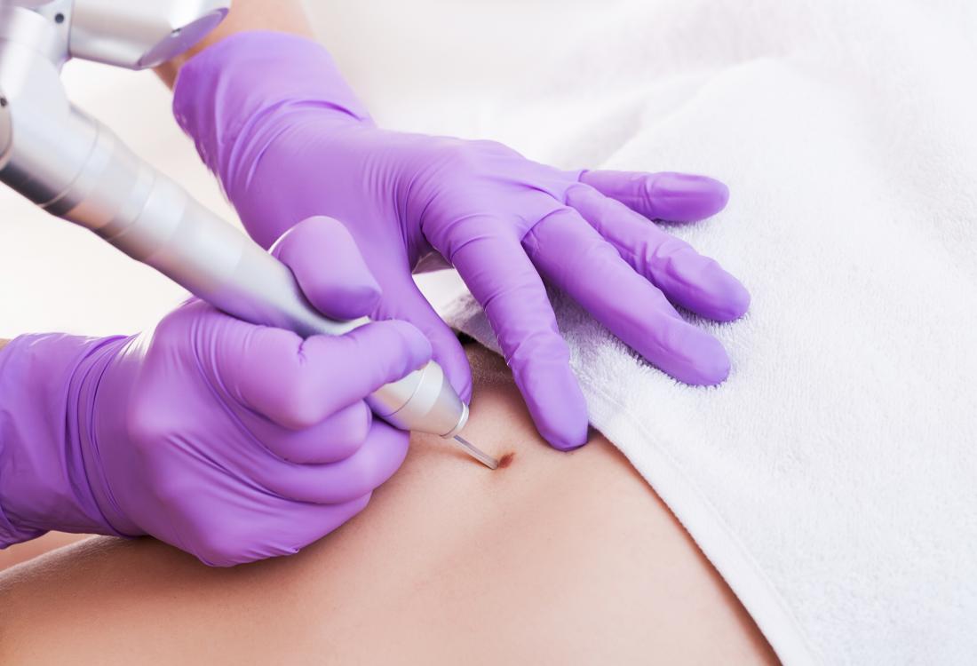 removing mole cryotherapy