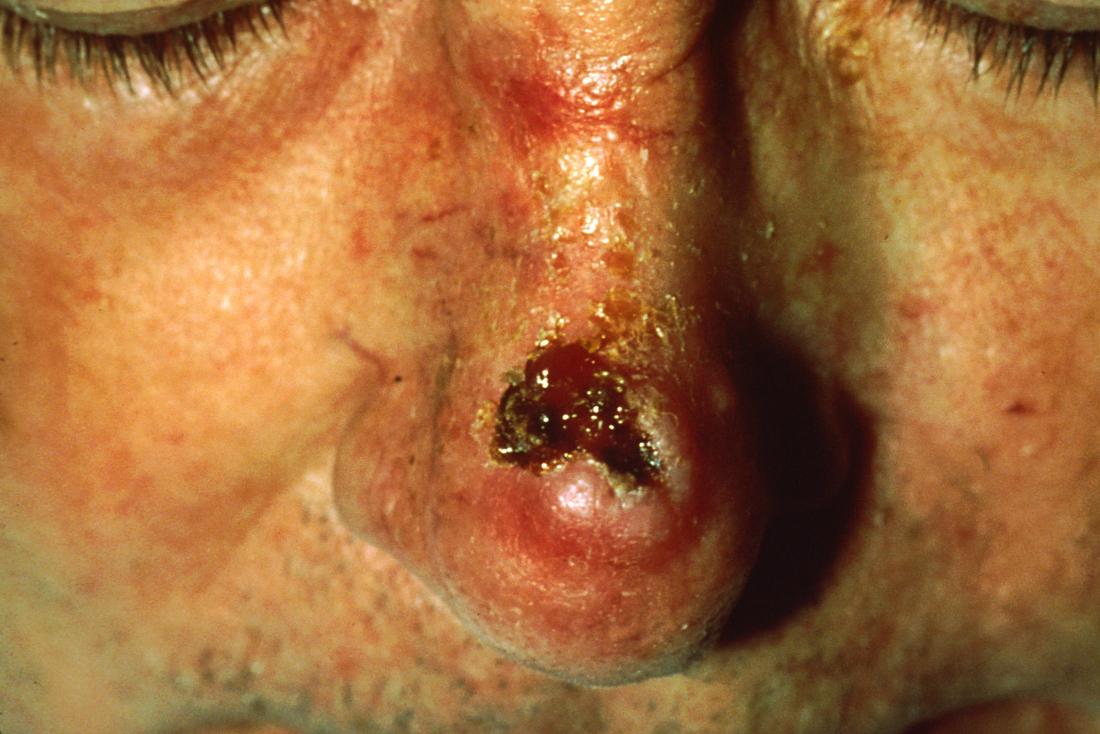 Squamous cell carcinoma