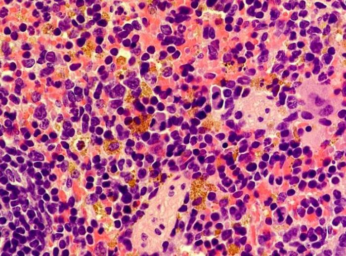 Hemosiderin