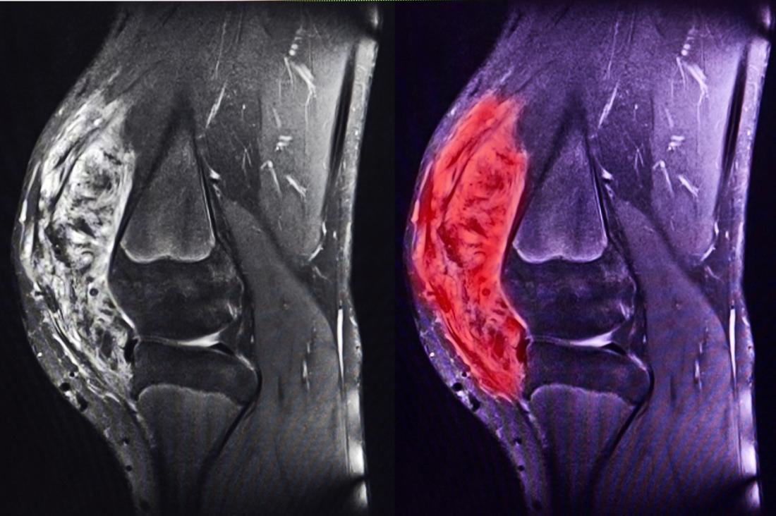 sarcoma-symptoms-types-treatments-and-causes