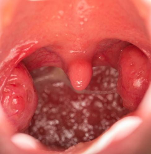 Tonsils in the throat.