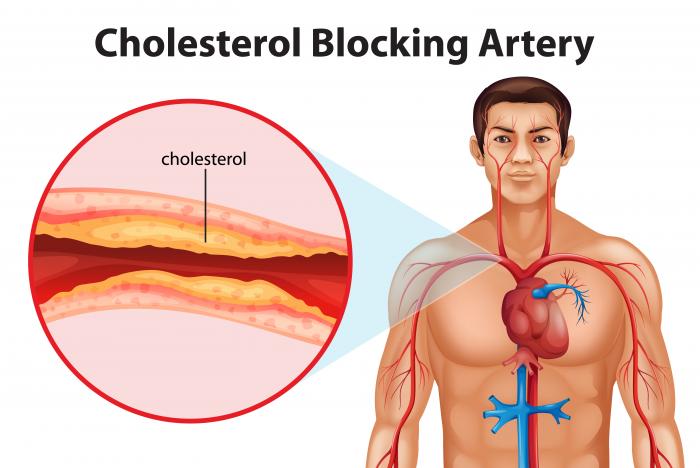 diagram of cholesterol blocking artery