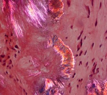 Area of a tophus where crystals appear on cellular tissue