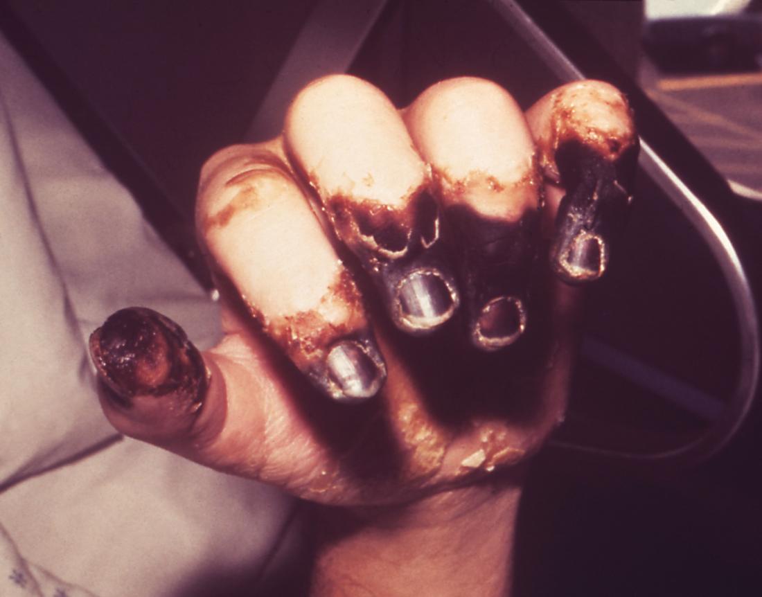 Septicaemia can lead to gangrene