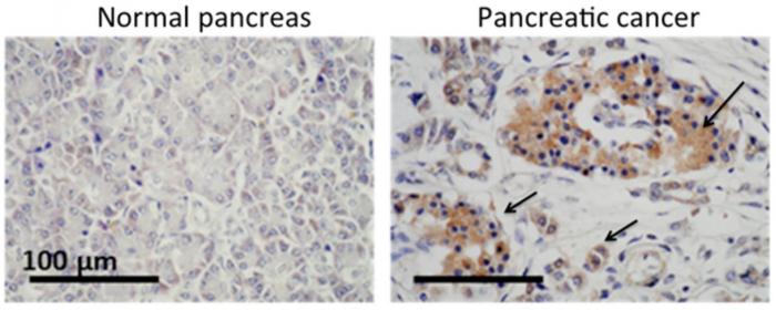 Normal pancreas and pancreatic cancer cells