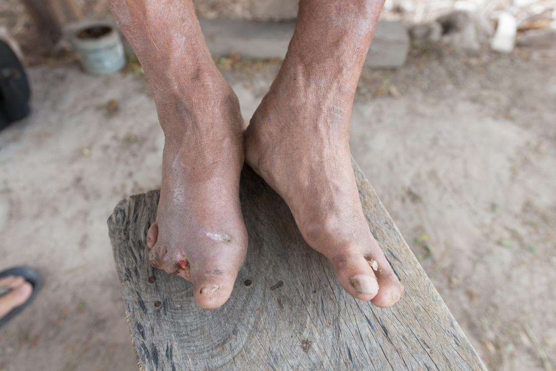 Leprosy Symptoms, diagnosis, and treatment