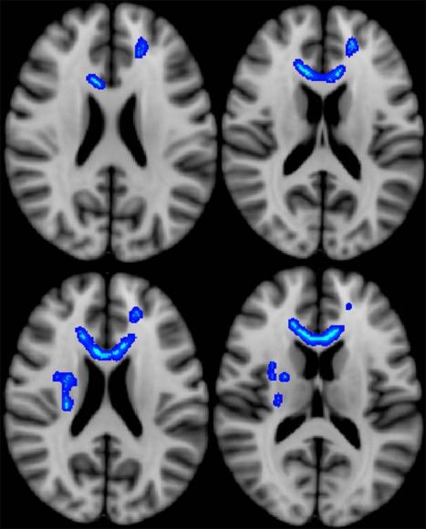 Imaging Predicts Long-Term Effects in Veterans with Brain Injury