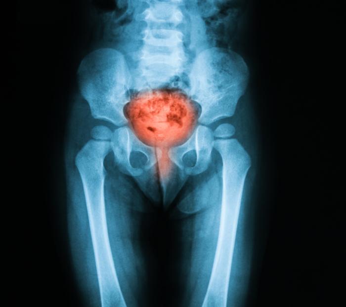 pelvic x-ray highlighting bladder