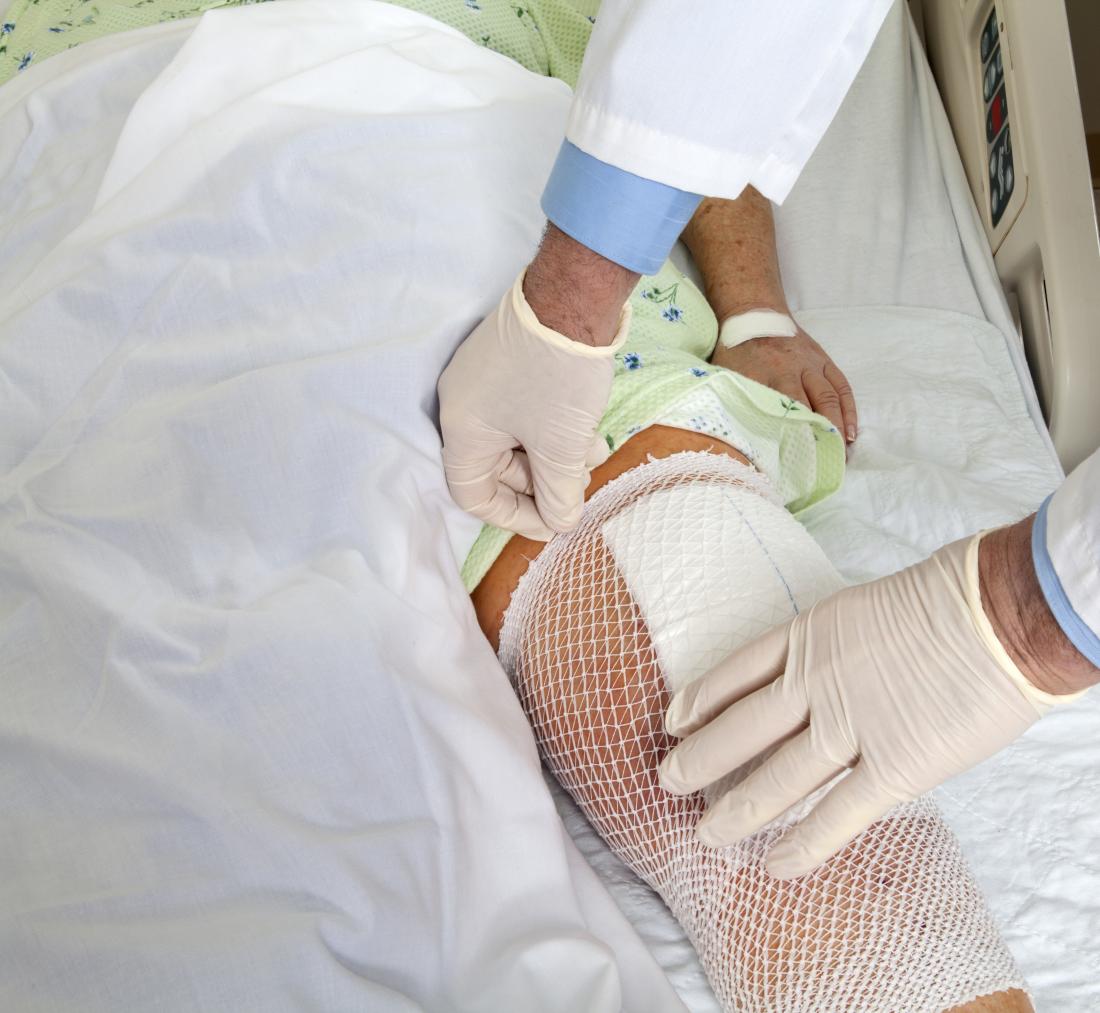 Knee replacement
