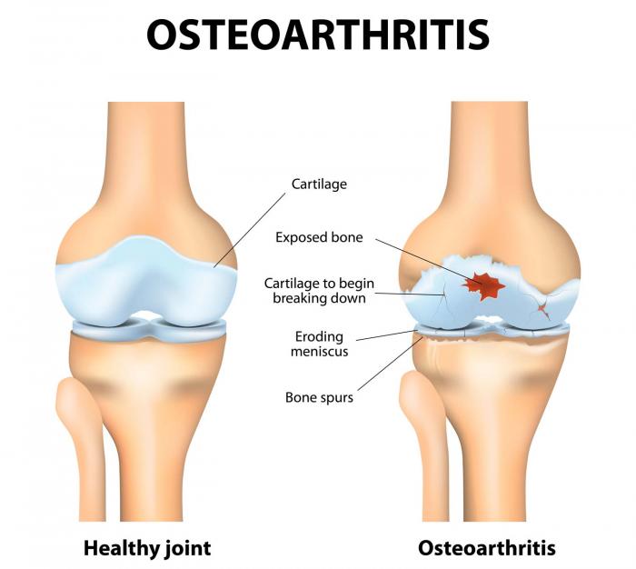 Bone pain treatment at home