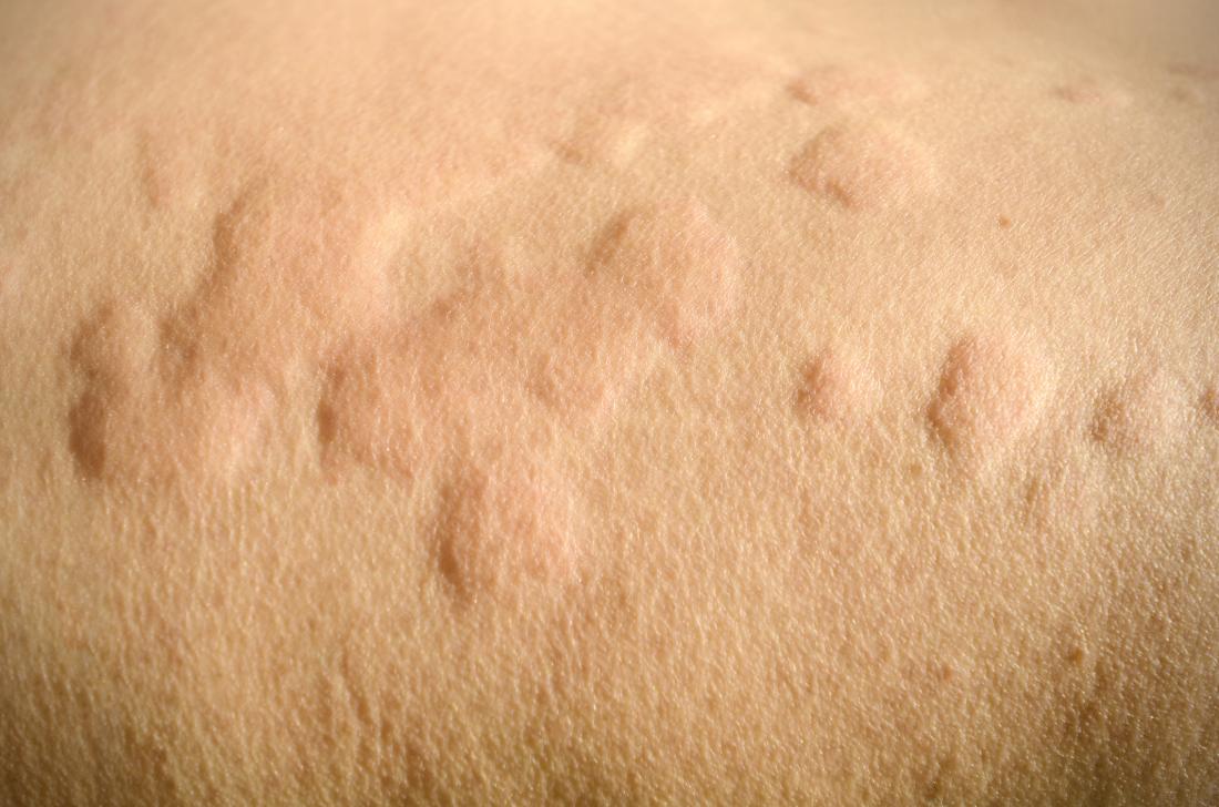 Allergic reaction rashes treatment