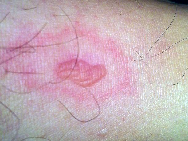 What Does A Brown Recluse Bite Look Like At First - Brown Recluse ...