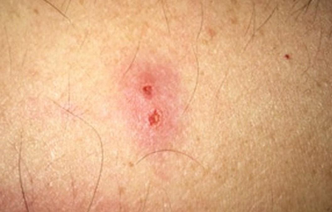 Spider Bites Identification And Treatment