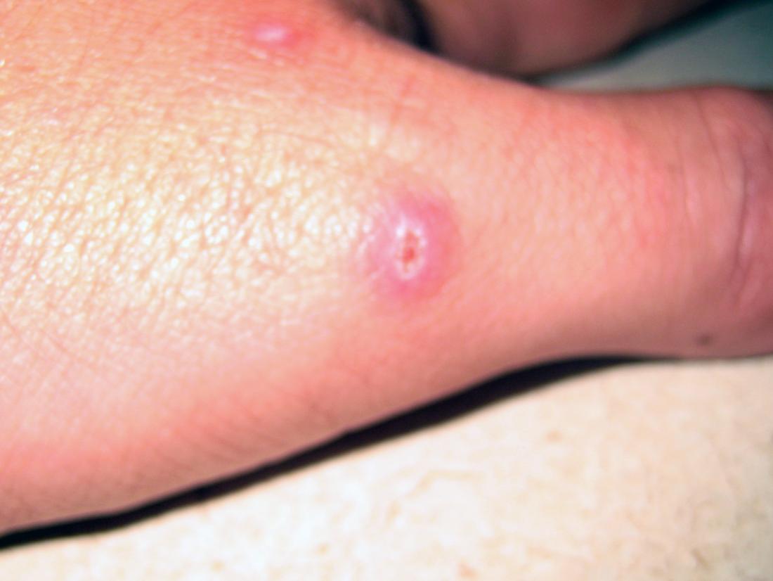 Spider Bites On Legs Itchy