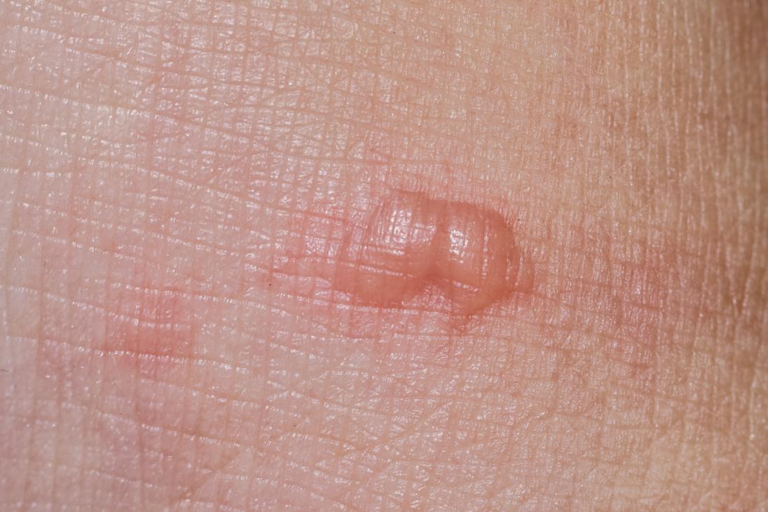 a small bump or blister