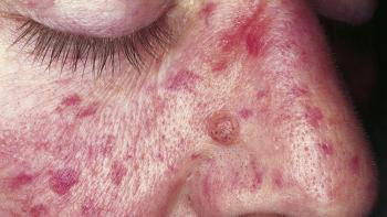Purpura Types Causes Diagnosis And Treatment