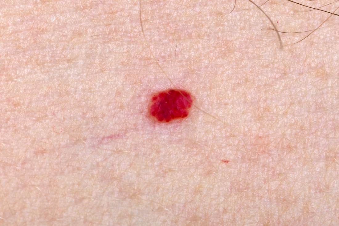 superficial hemangioma