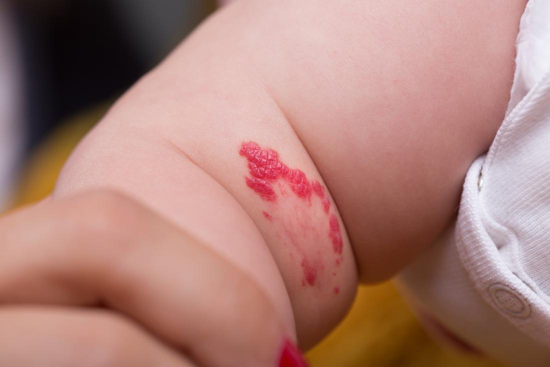 superficial hemangioma