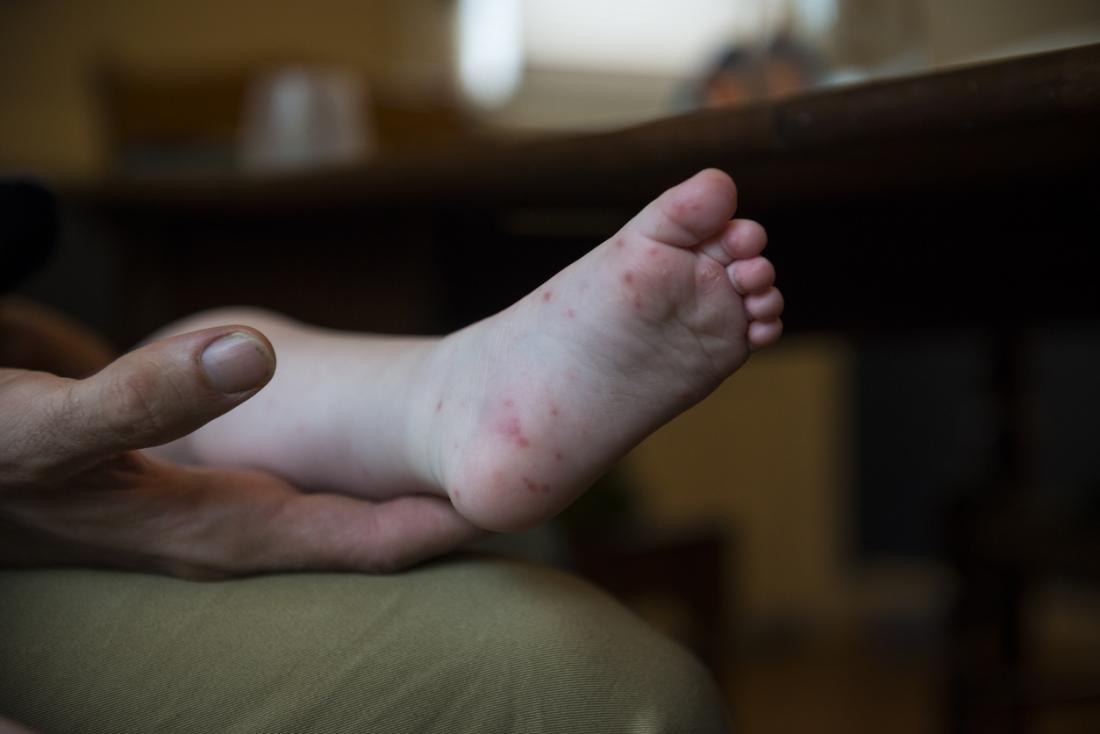 Hand, foot, and mouth disease Symptoms, causes, and treatment photo