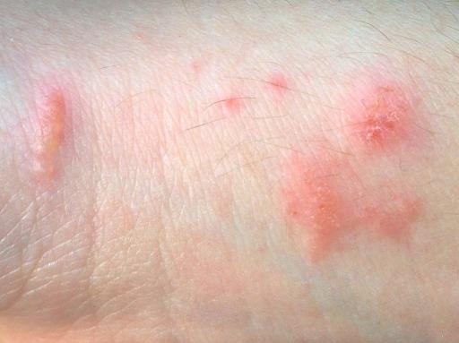 What does the beginning stages of poison ivy look like Poison Oak Rash Photos And Treatment Options