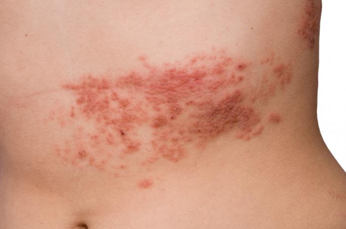 Shingles rash on a torso.