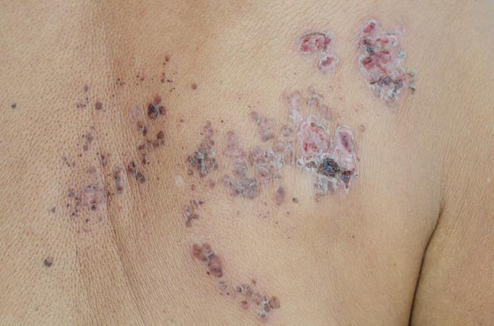 Shingles scabs.