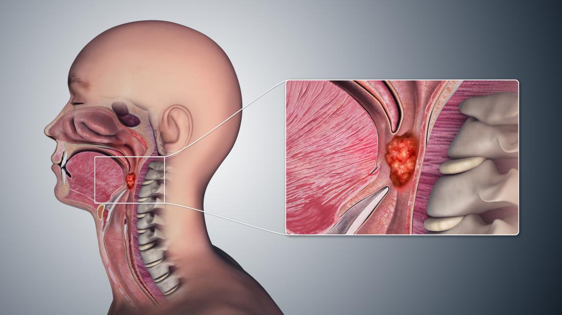 Throat Cancer Symptoms Pictures Causes And Treatment