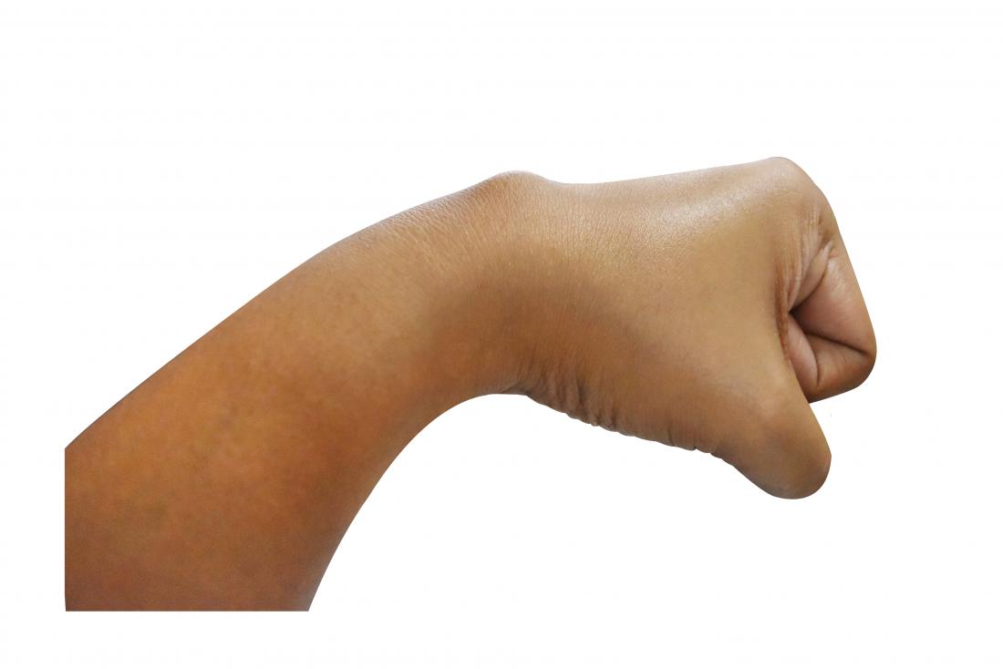 a dome shaped cyst