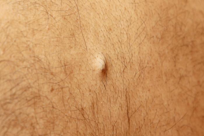 A sebaceous cyst on a hairy back.